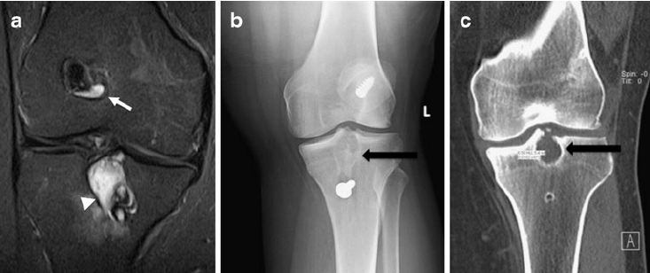 Femoral cyst