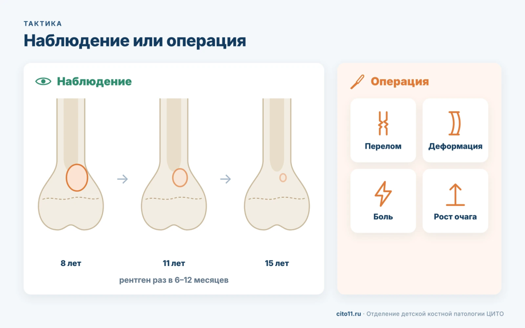 Тактика при НОФ у детей: очаг заполняется костью при наблюдении, операция при переломе, деформации, боли и росте очага