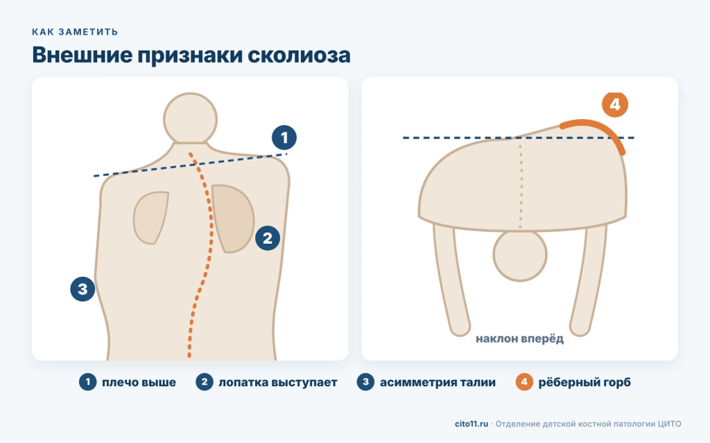 Внешние признаки сколиоза у подростка: плечо выше, лопатка выступает, асимметрия талии, рёберный горб при наклоне вперёд