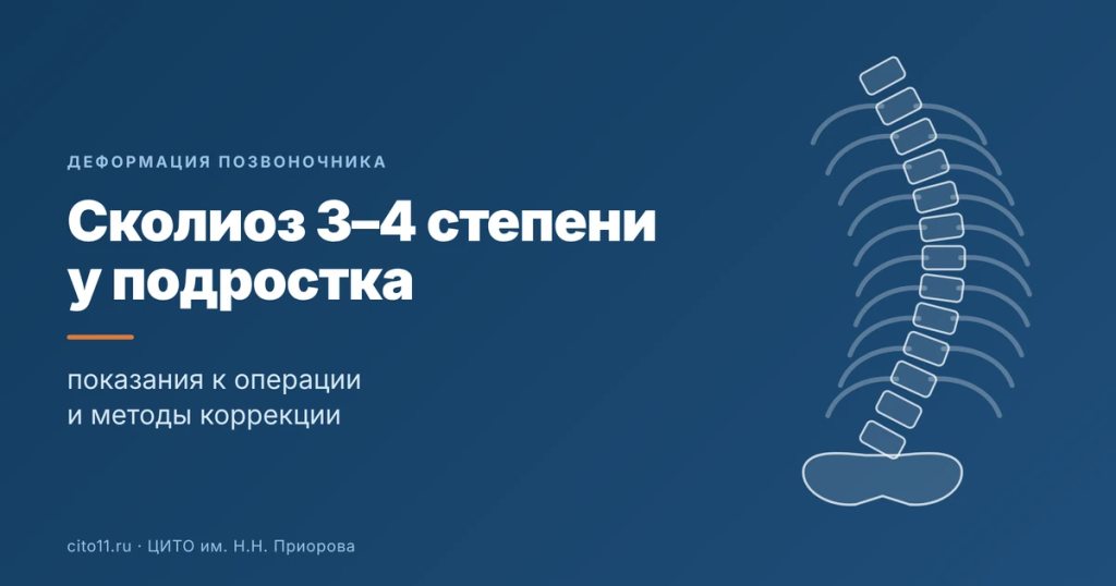 Сколиоз 3–4 степени у подростка: показания к операции и методы коррекции
