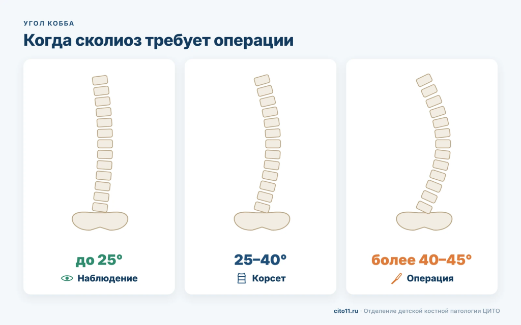 Тактика при сколиозе по углу Кобба: до 25° наблюдение, 25–40° корсет, более 40–45° операция