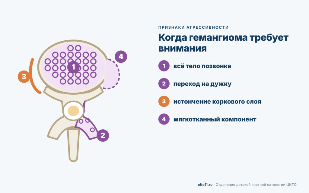 Признаки агрессивной гемангиомы позвонка: всё тело позвонка, переход на дужку, истончение коркового слоя, мягкотканный компонент