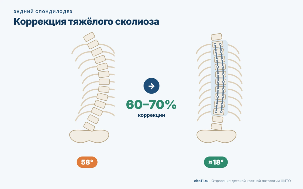 Коррекция тяжёлого сколиоза задним спондилодезом: позвоночник до и после операции, коррекция 60–70%