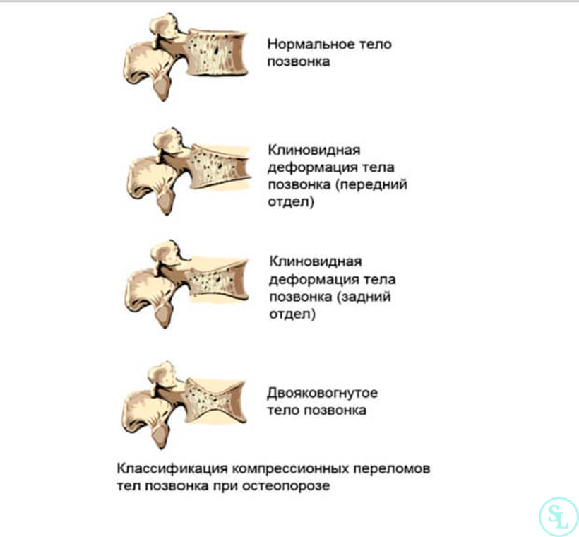 Клиновидные позвонки