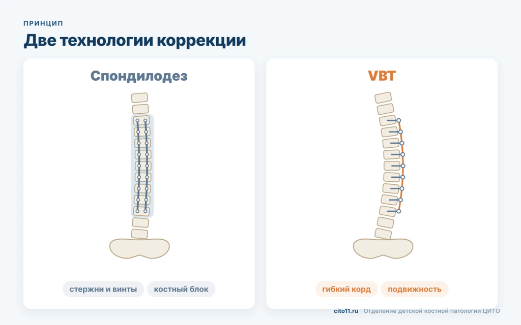 Спондилодез со стержнями и костным блоком и VBT с гибким кордом: схема двух методов коррекции сколиоза