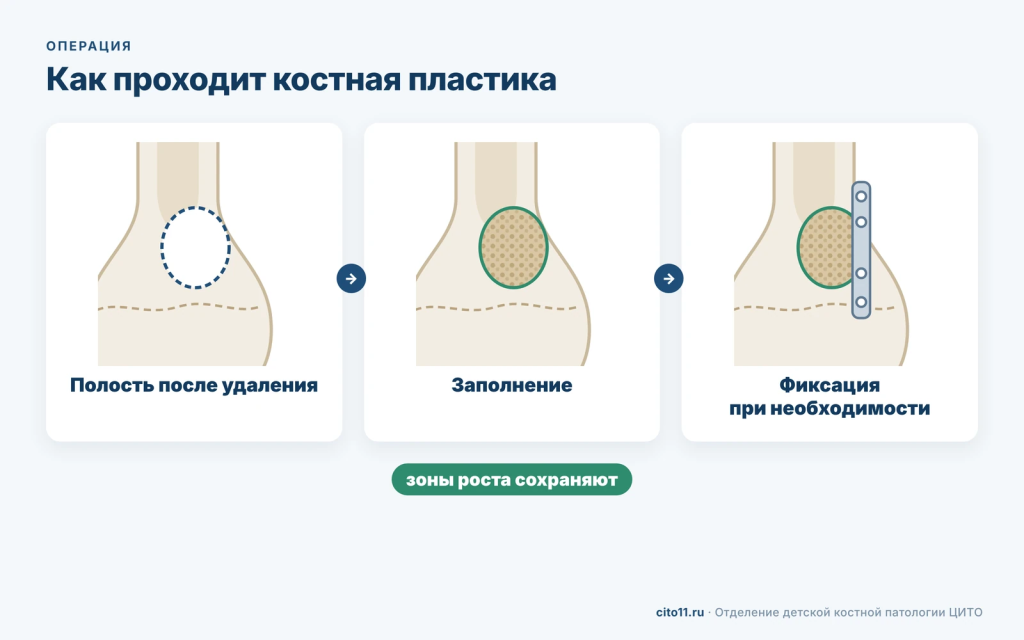 Этапы костной пластики: полость после удаления очага, заполнение трансплантатом, фиксация при необходимости