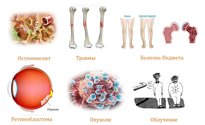 Причины образования первичных опухолей костей