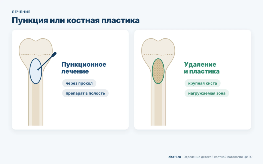 Лечение солитарной кисты кости: пункционное введение препарата или удаление с костной пластикой