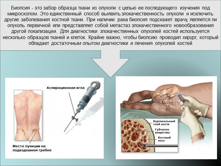 биопсия