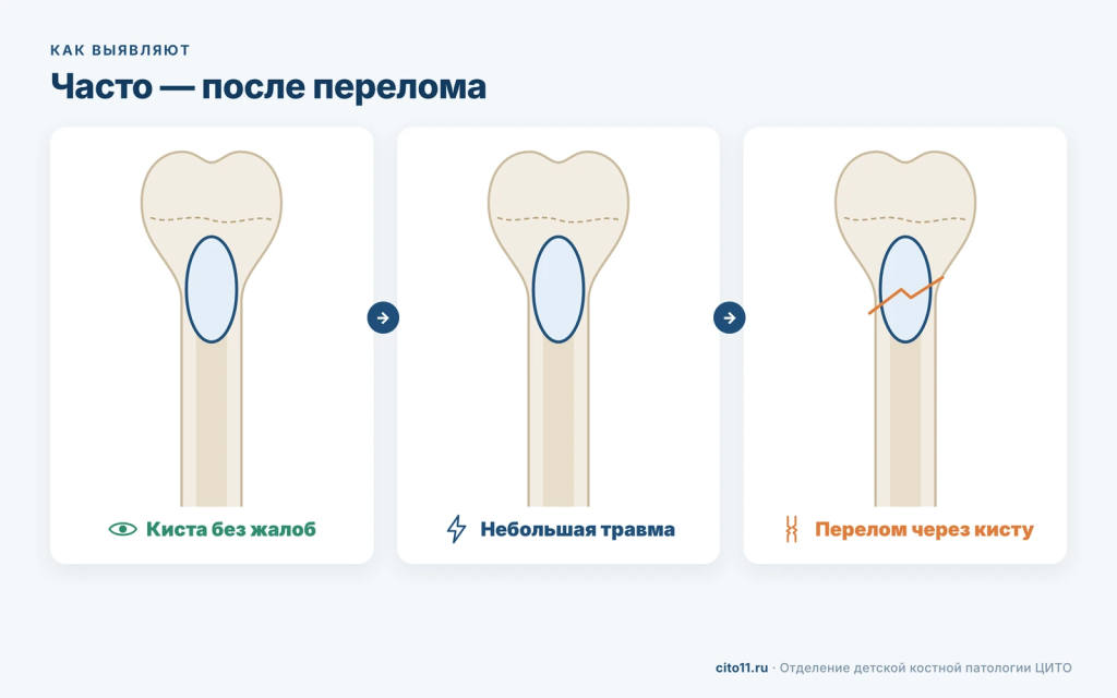 Солитарная киста кости долго протекает без жалоб и часто выявляется после патологического перелома