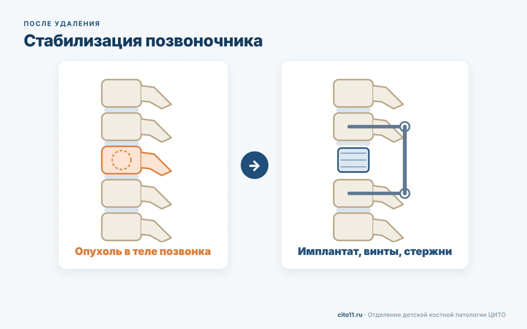 Стабилизация позвоночника после удаления опухоли: имплантат вместо тела позвонка, винты и стержни