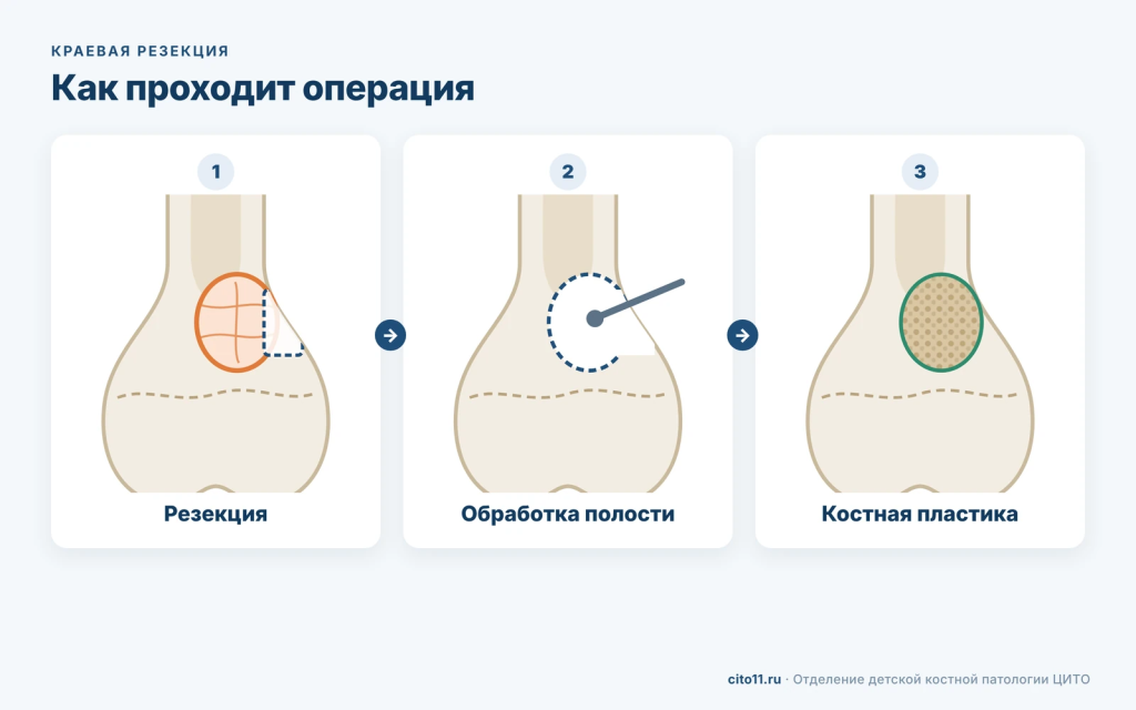 Этапы краевой резекции кости с костной пластикой у ребёнка: резекция, обработка полости, заполнение трансплантатом