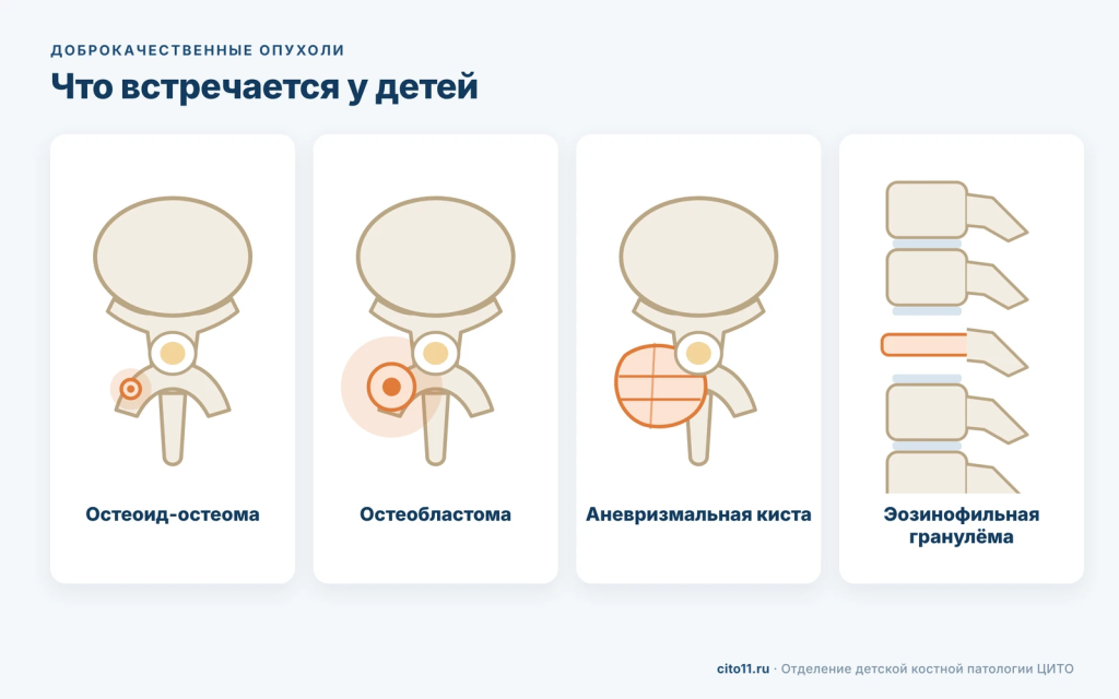 Доброкачественные опухоли позвоночника у детей: остеоид-остеома, остеобластома, аневризмальная киста, эозинофильная гранулёма