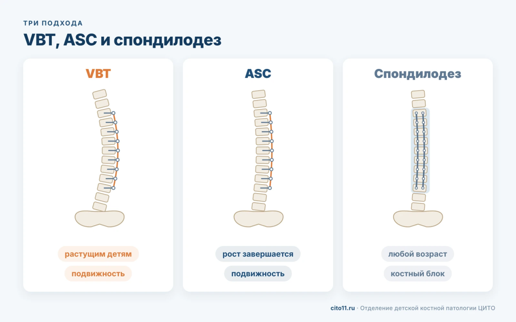 Схема трёх операций при сколиозе: VBT и ASC с гибким кордом, спондилодез со стержнями и костным блоком