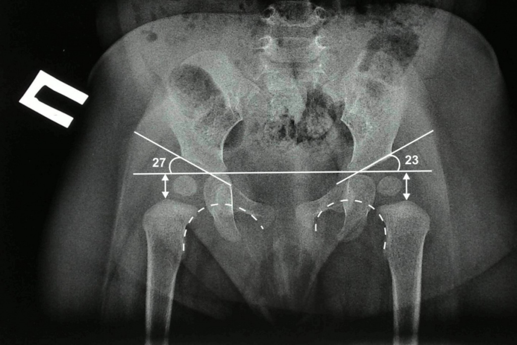 Рентгенодиагностика дисплазий тазобедренного сустава
