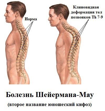 Болезни Шейермана-Мау