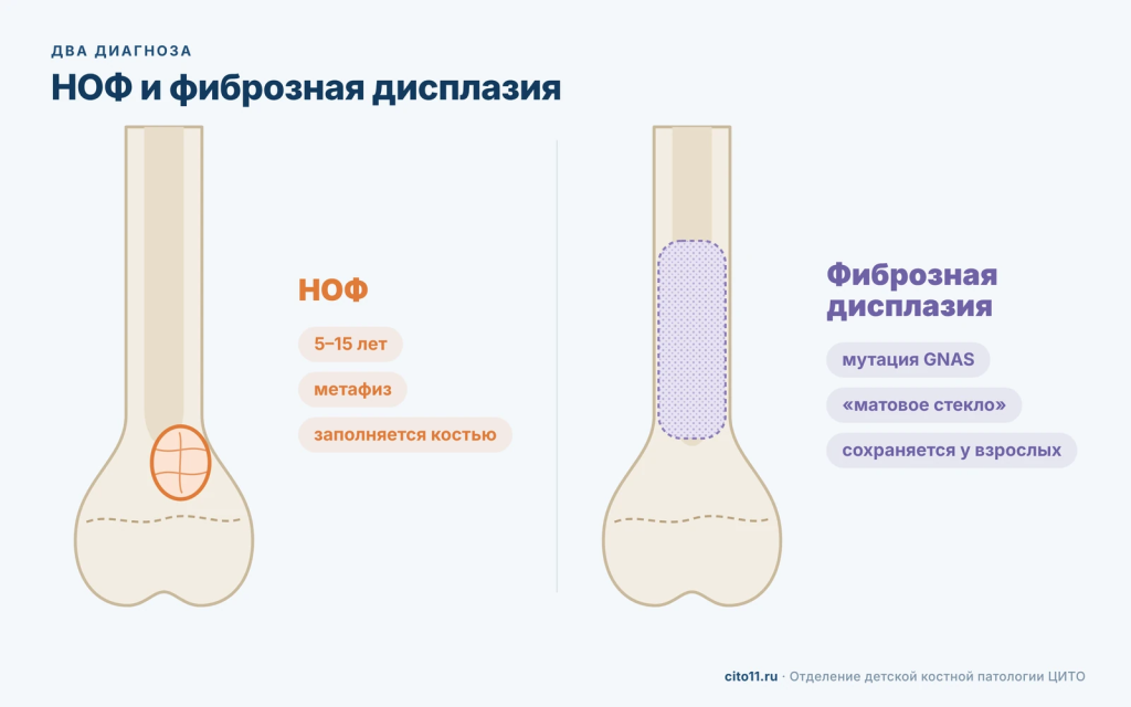 Неоссифицирующая фиброма в метафизе и фиброзная дисплазия в диафизе бедренной кости: схема