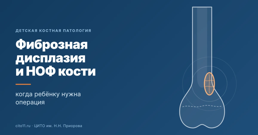 Фиброзная дисплазия и неоссифицирующая фиброма кости у ребёнка: когда нужна операция
