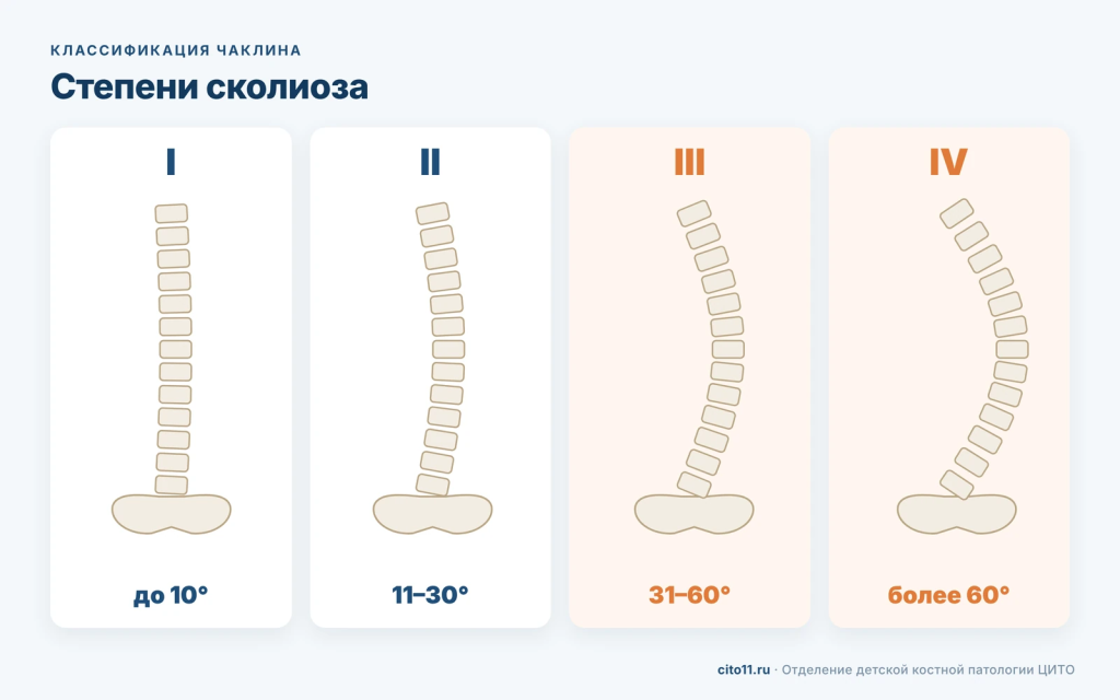 Степени сколиоза по Чаклину: I до 10°, II 11–30°, III 31–60°, IV более 60°