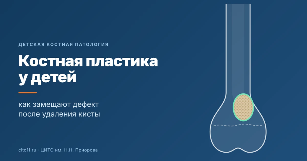 : Костная пластика у детей: замещение дефекта после удаления кисты или опухоли