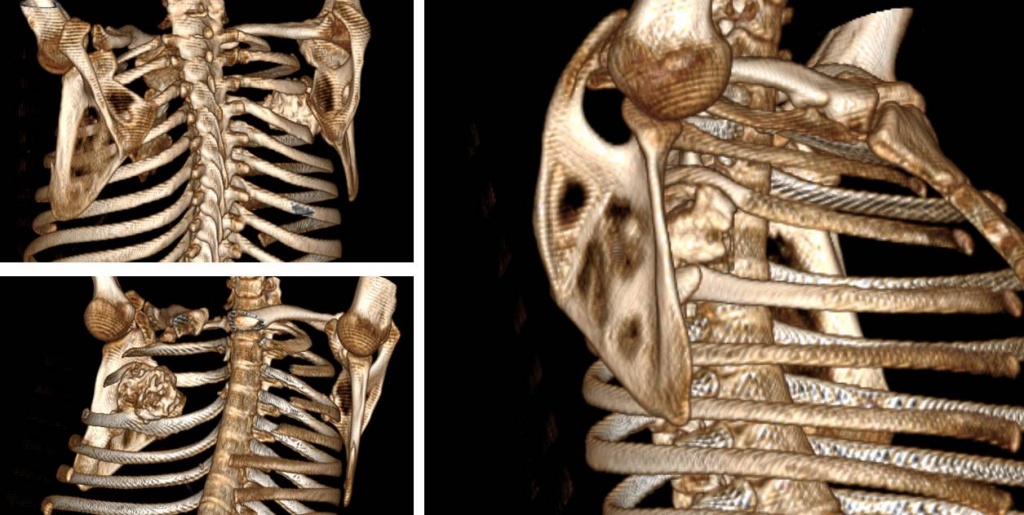 Хондрома костей грудной клетки и других плоских костей