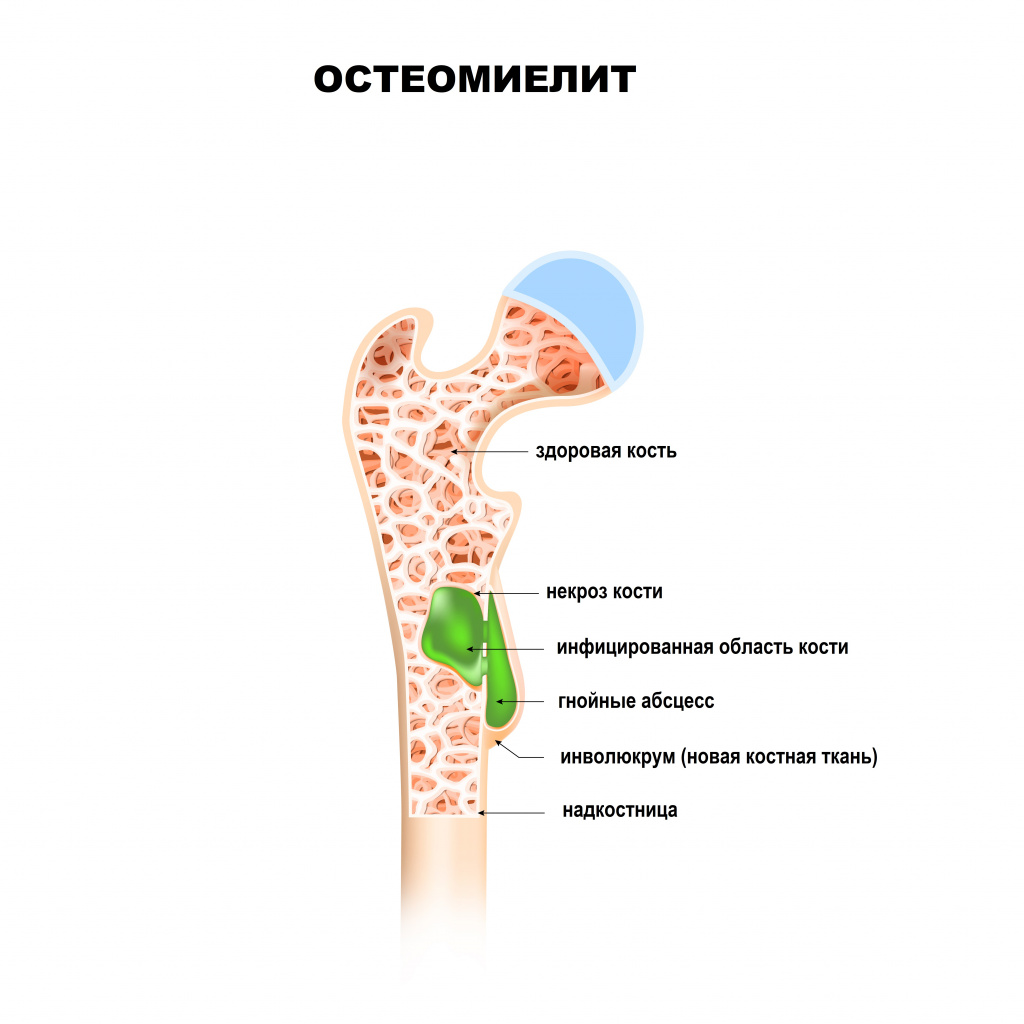 Острый остеомиелит клиническая картина