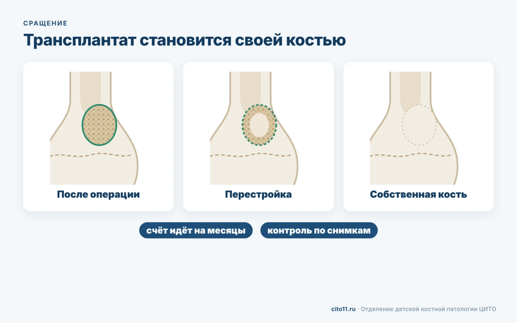 Перестройка костного трансплантата: со временем он замещается собственной костью ребёнка