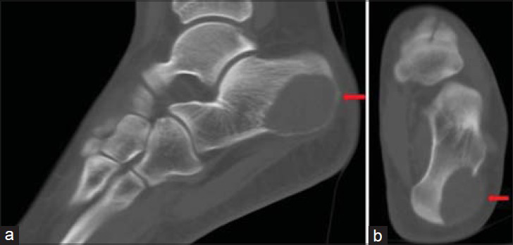 Cyst of the foot: calcaneus, talus