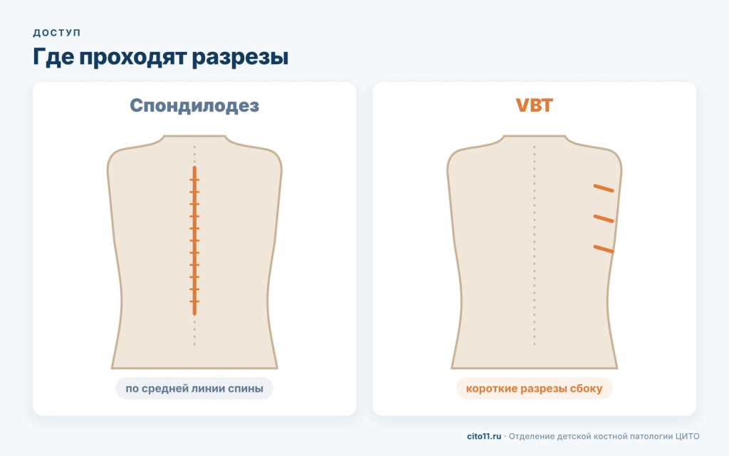 Разрезы при спондилодезе по средней линии спины и при VBT короткими разрезами сбоку