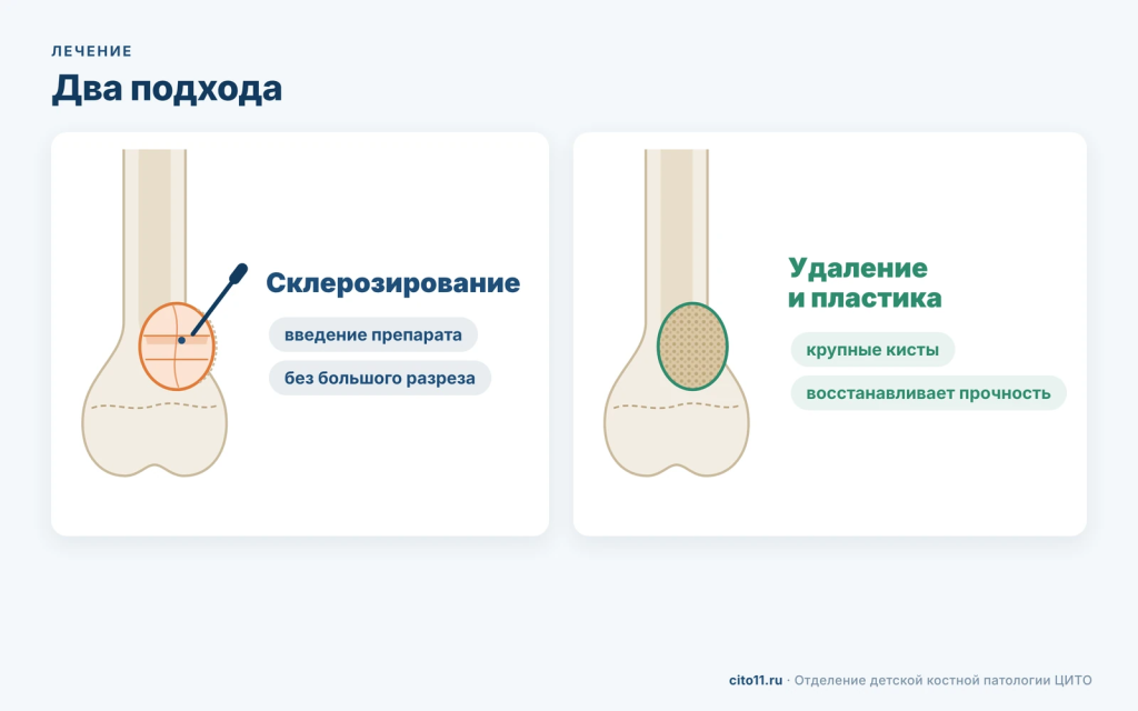 Лечение аневризмальной кисты кости: склерозирование через прокол или удаление с костной пластикой