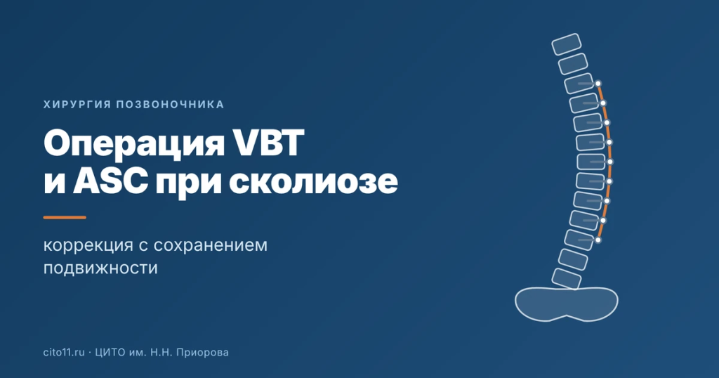 Операция VBT и ASC при сколиозе у детей: коррекция с сохранением подвижности
