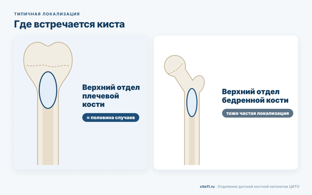 Солитарная киста кости у детей чаще всего в верхнем отделе плечевой кости — около половины случаев — и в верхнем отделе бедренной кости
