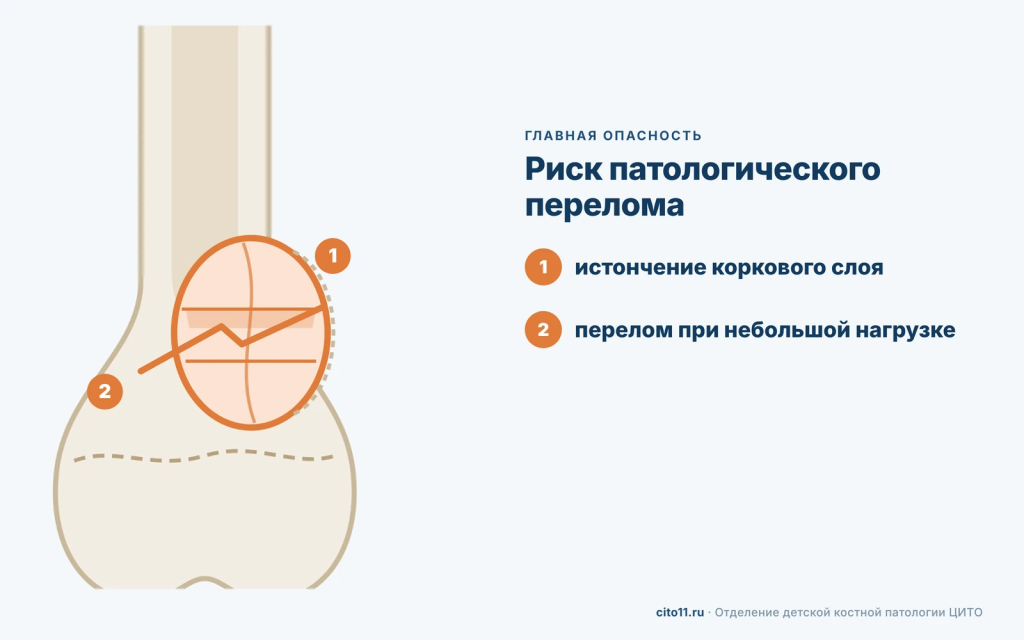 Риск патологического перелома при аневризмальной кисте: истончение коркового слоя и перелом при небольшой нагрузке