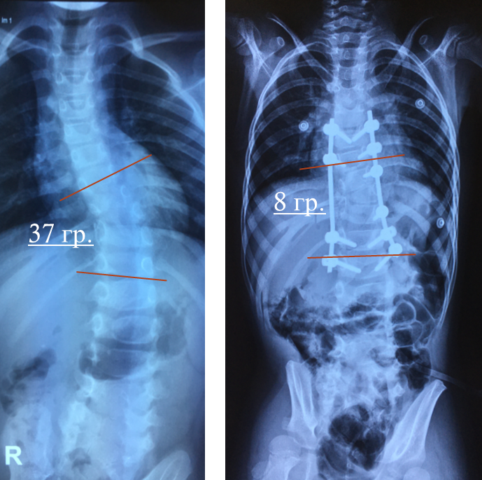 Врожденный левосторонний грудопоясничный сколиоз 3 ст. Смешанные аномалии развития грудного и поясничного отделов позвоночника.