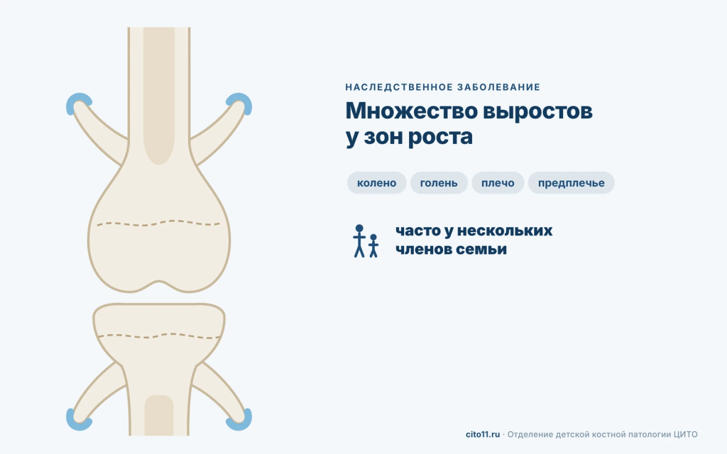 Множественные экзостозы у зон роста бедренной и большеберцовой костей при наследственной экзостозной хондродисплазии