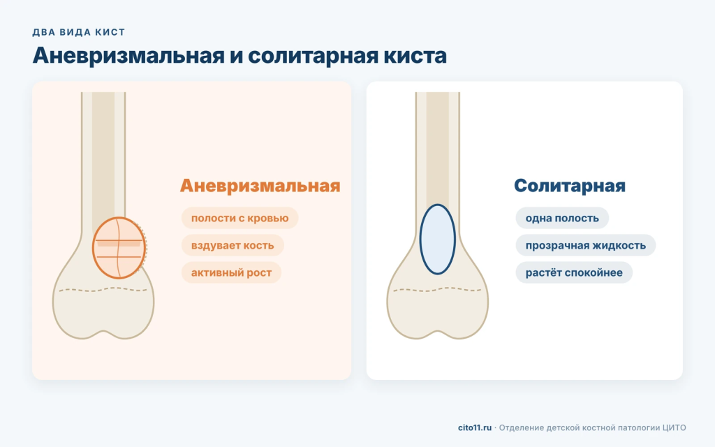 Аневризмальная и солитарная киста кости: полости с кровью, вздутие кости и активный рост против одной полости с прозрачной жидкостью