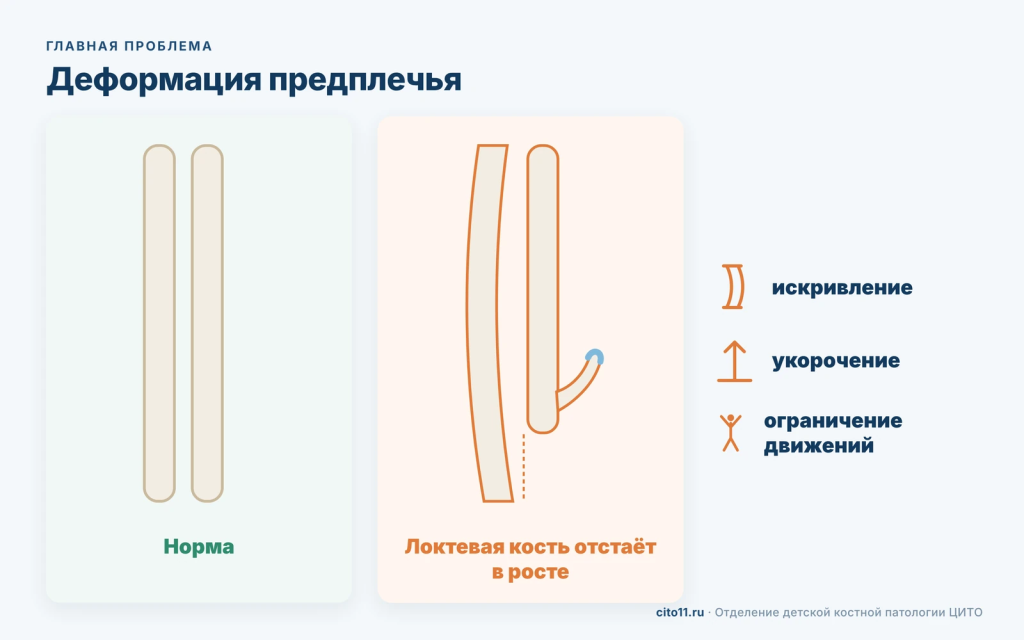 Деформация предплечья при множественных экзостозах: локтевая кость отстаёт в росте, лучевая искривляется