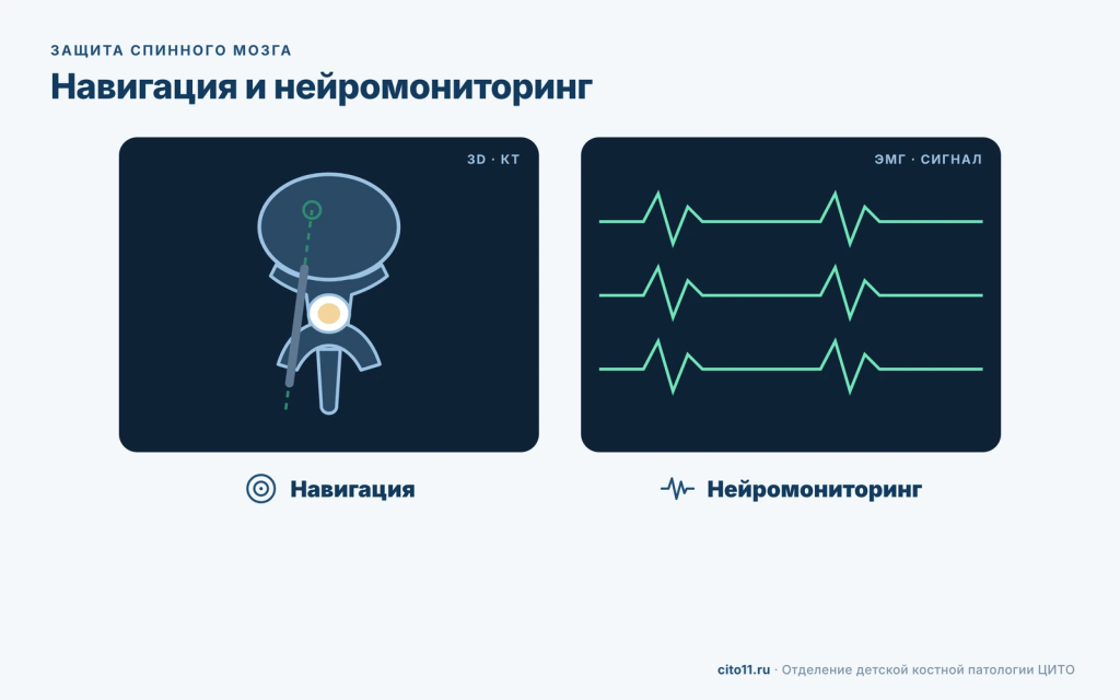 Навигация по КТ и интраоперационный нейромониторинг при операции на позвоночнике у ребёнка