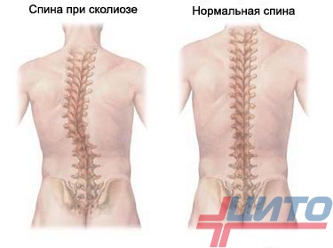 Боли в спине — это самая частая причина обращения к неврологу