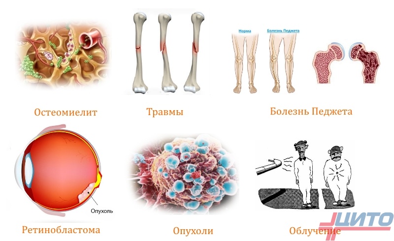 Причины образования первичных опухолей костей