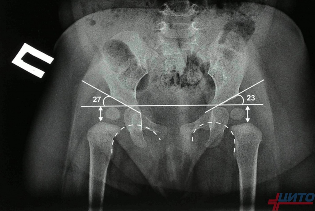 Что такое тбс. Дисплазия тазобедренных суставов Рент. Рентген тазобедренных суставов у детей норма. Дисплазия тазобедренных суставов рентген норма.