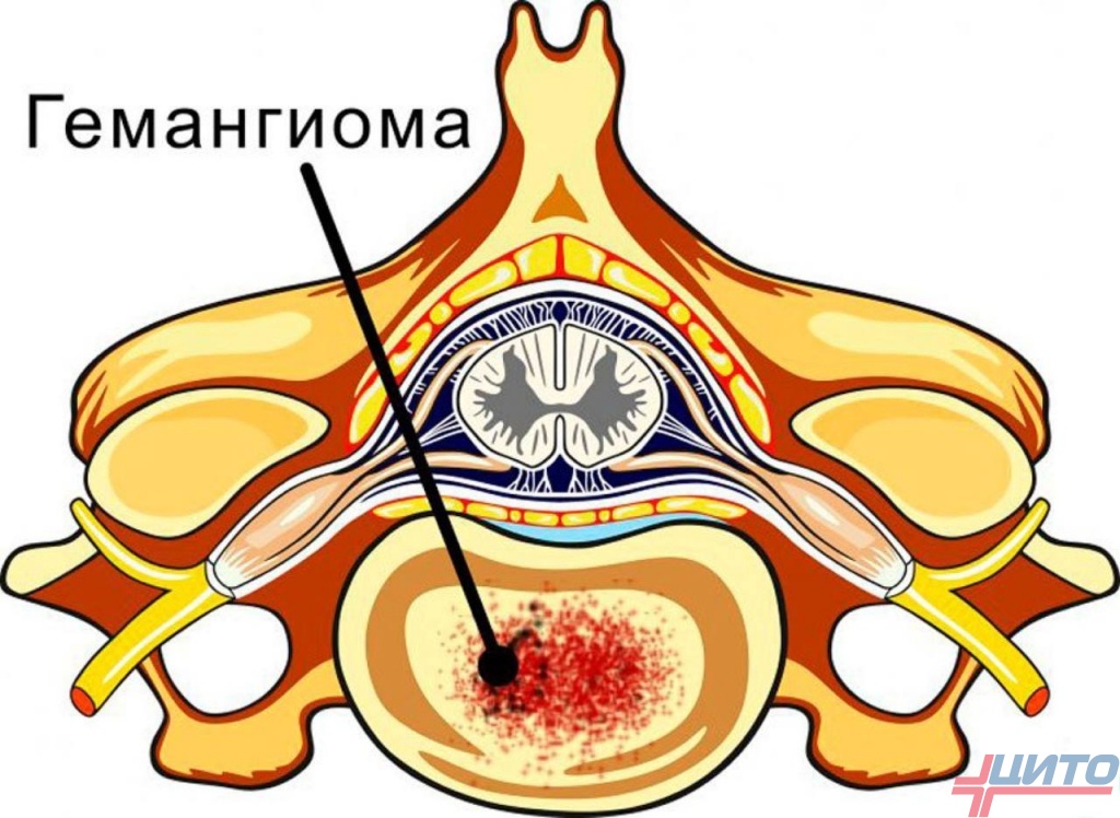 Симптомы гемангиомы позвоночника грудного отдела